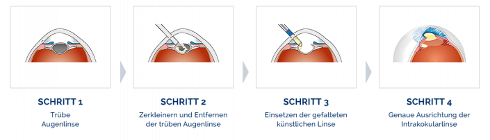 grauer-star-kunstlinse-intraokularlinse-katarakt-behandlung-operation ...